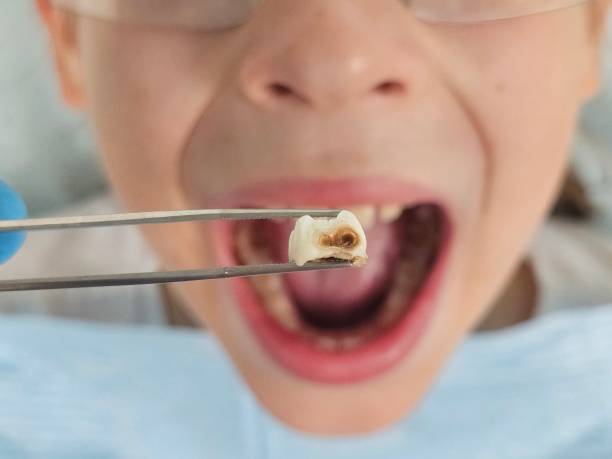Best Emergency Tooth Extraction in West Vero Corridor, FL